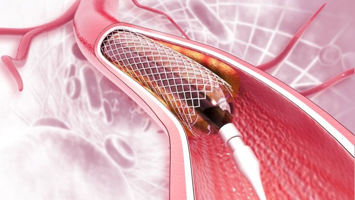 হার্টের রিংয়ের নতুন দাম ১ লক্ষ টাকা, অক্টোবর থেকে কার্যকর