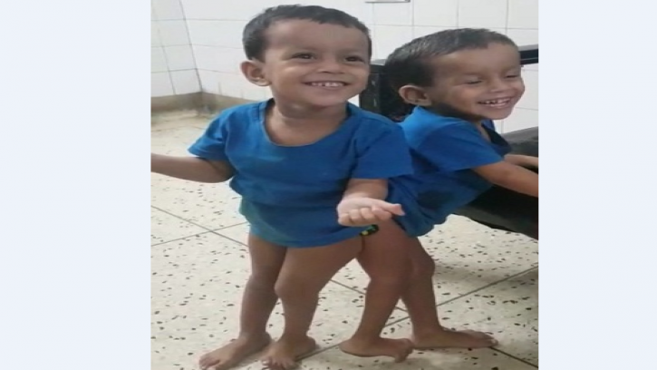 জোড়া শিশু লাবিবা-লামিসার অস্ত্রোপচার সোমবার (ভিডিও)